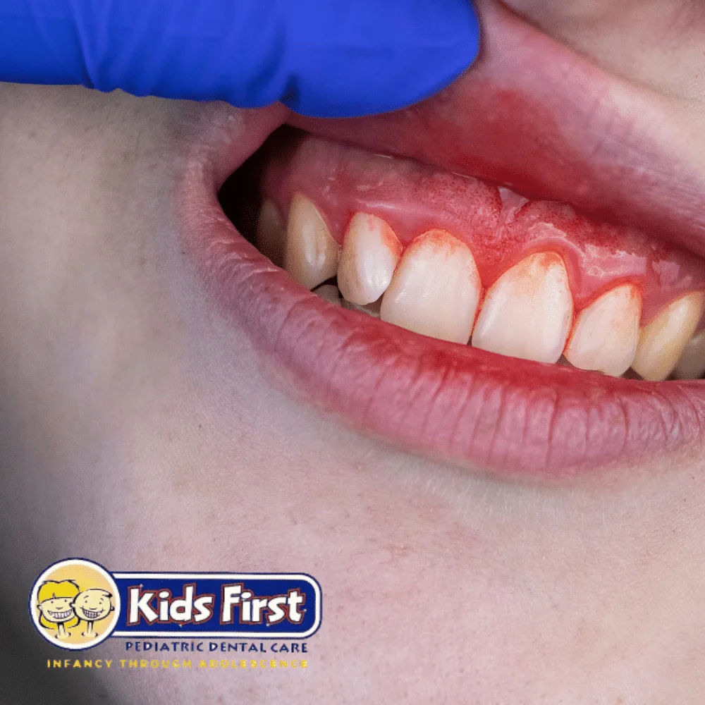 Illustration for Gum Disease in Children-How to Spot the Signs.
